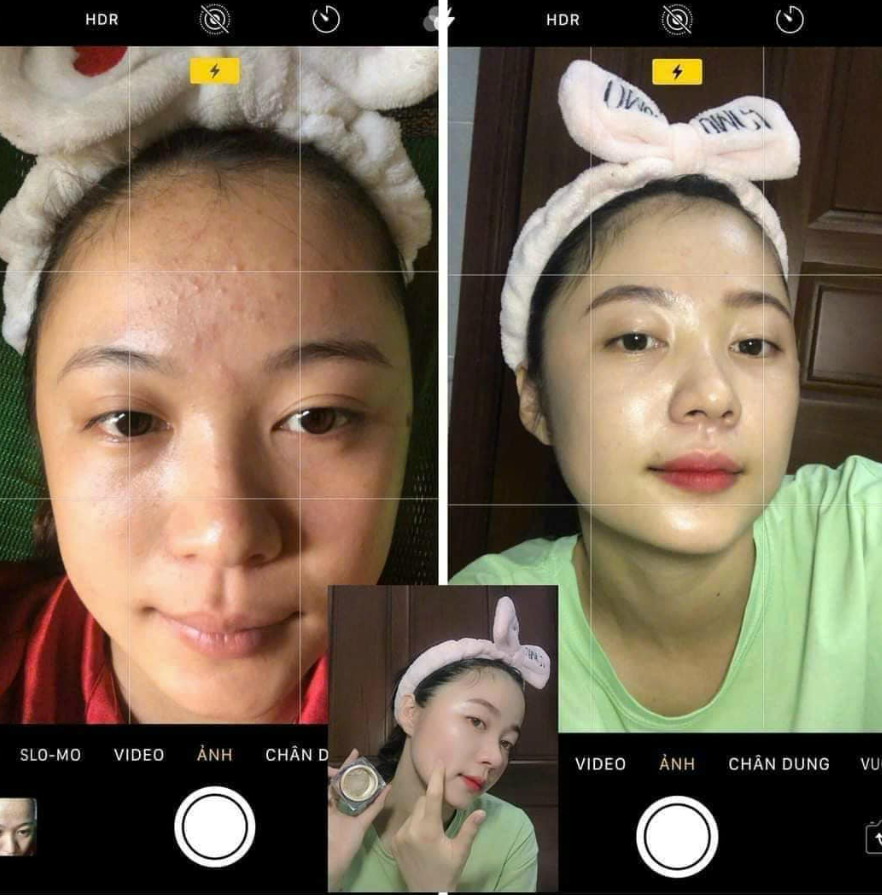Hiệu quả sau khi khách hàng sử dụng Cao Mụn Đông Y 36 Vị