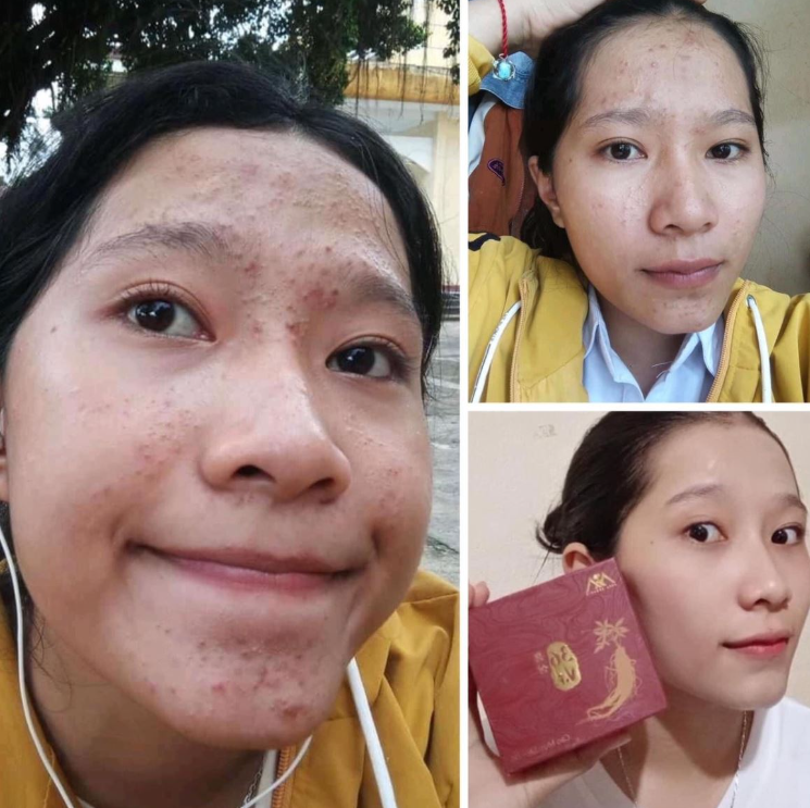 Review cao mụn Sâm Đỏ từ khách hàng