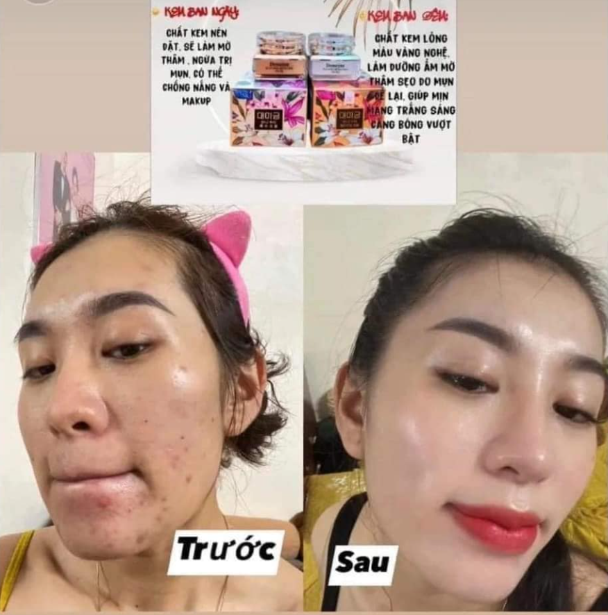 Thành phần kem chủ yếu là chất kháng khuẩn, các loại vitamin E, A, D có tác dụng làm trẻ hoá da