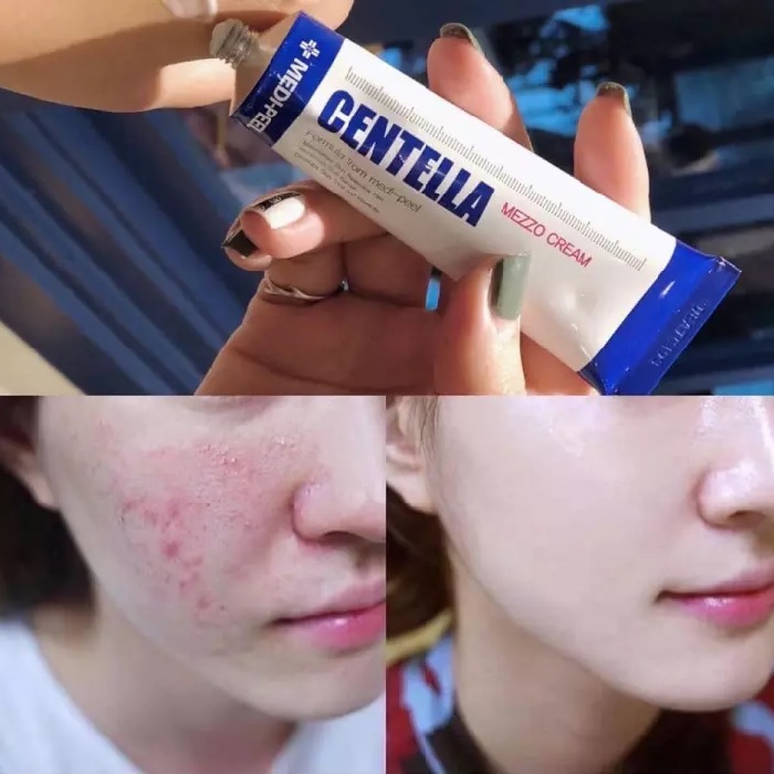Công dụng kem Centella Medi Peel