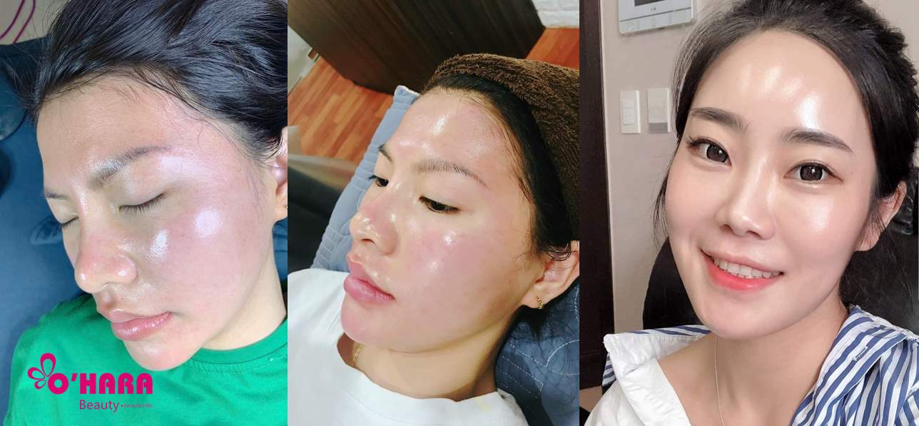 Làn da trở nên trắng mịn màng sau 1 thời gian tin dùng kem dưỡng B5 Mqskin