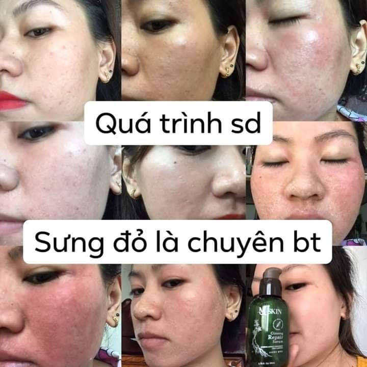 Biểu hiện khi sử dụng Serum Mq Skin