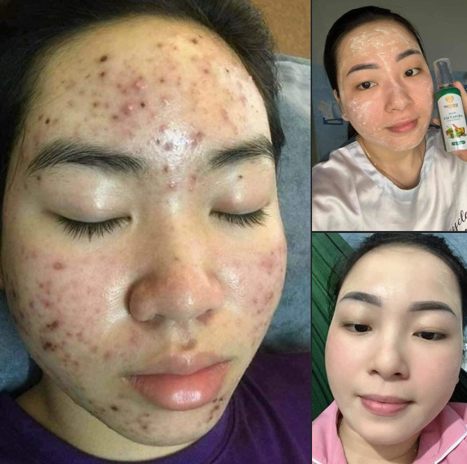 Hình ảnh khách hàng sau khi sử dụng Yody White Phương Anh