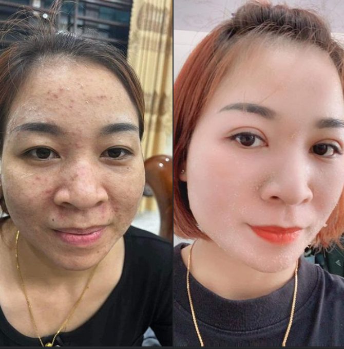 Review tái tạo da Phương Anh từ khách hàng