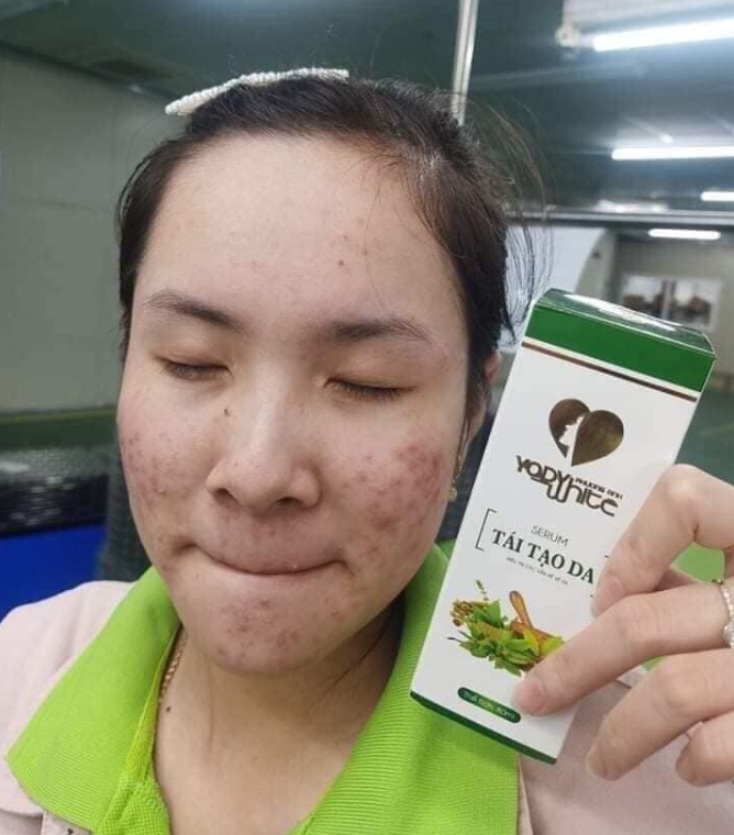 Biểu hiện và cách xử lý khi dùng tái tạo Yody White