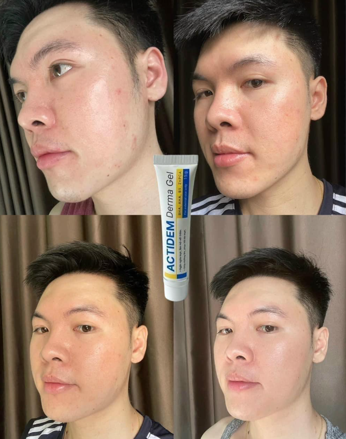 Cảm nhận thực tế sau khi dùng kem trị mụn actiderm derma gel