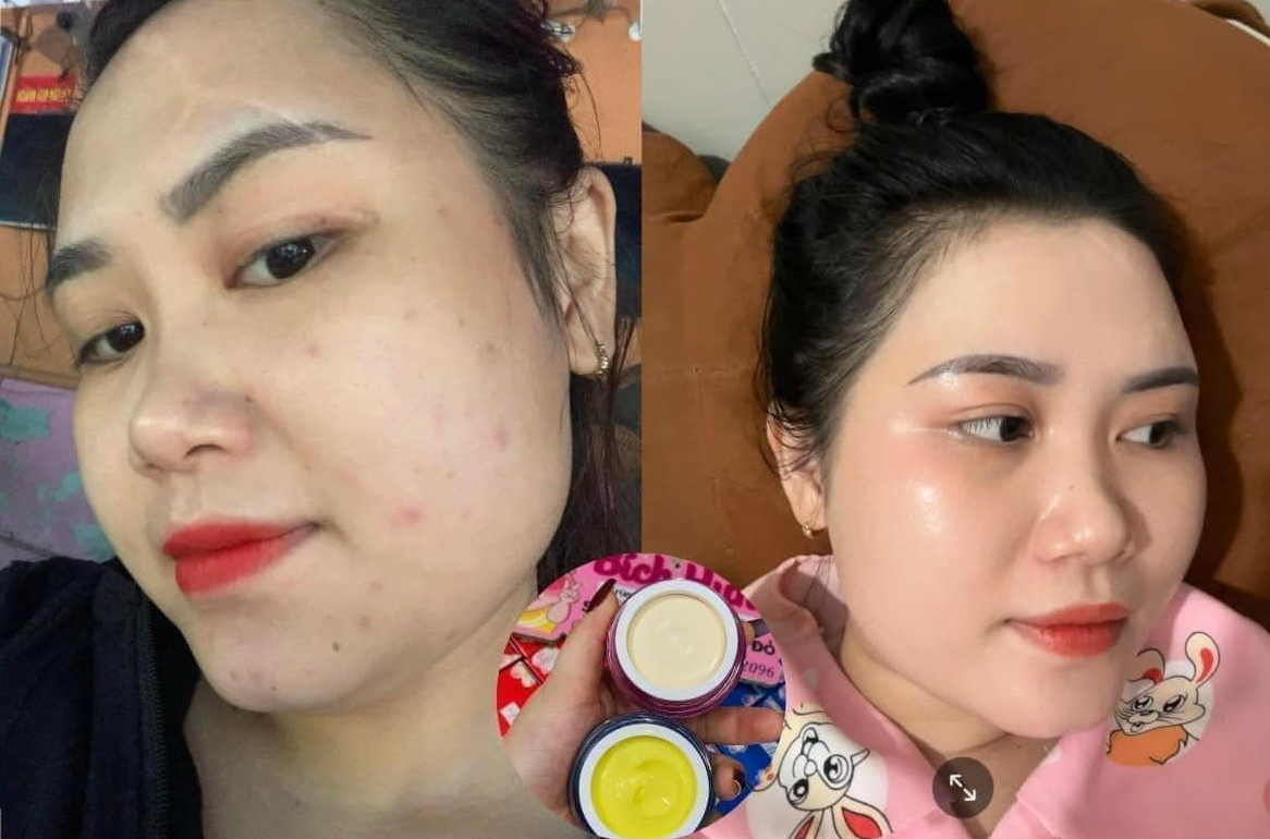 Hình ảnh khách hàng sau khi sử dụng Kem Meiduzi Chính Hãng