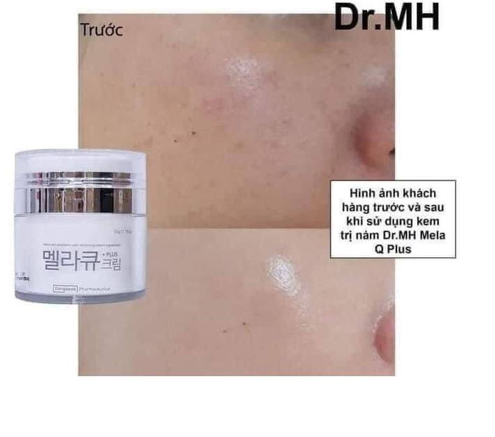 Công dụng của kem trị nám Mela M