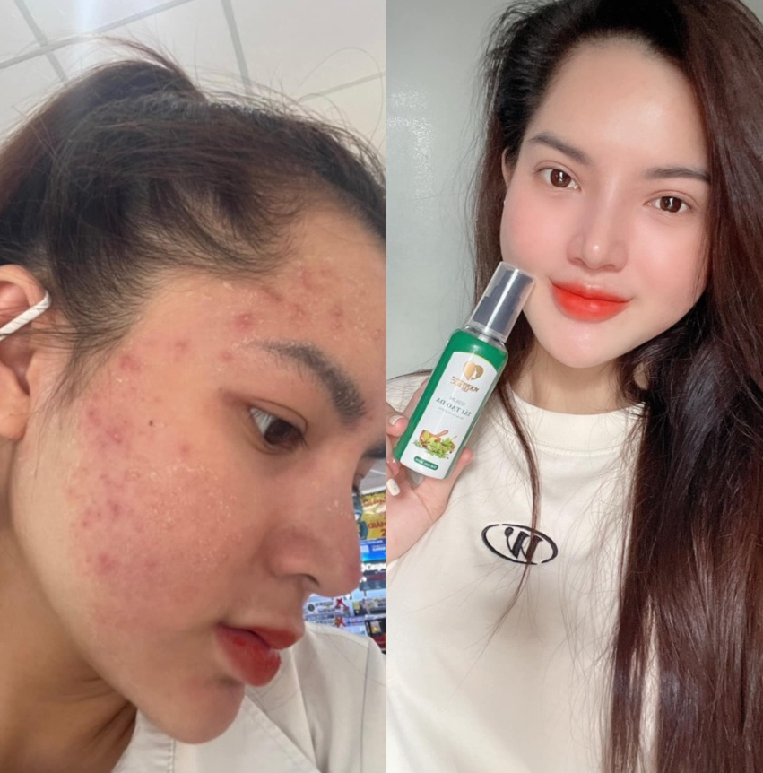 Thảo dược tái tạo da Phương Anh bao lâu bong da?