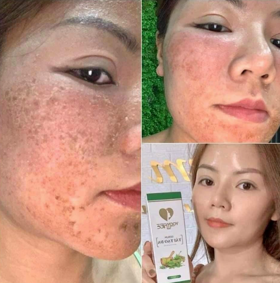 Tái tạo da yody Phương Anh