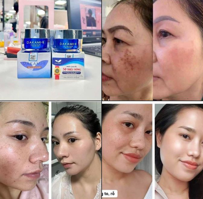 Kem Trị Nám Dakami II chính hãng - Oharabeauty