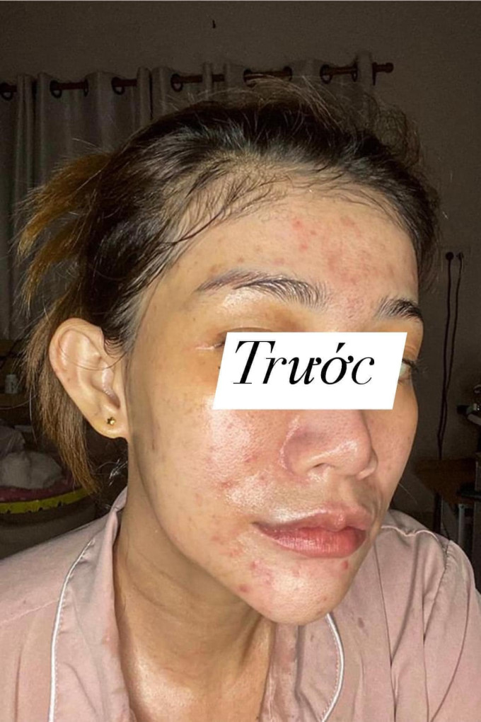 Cơ chế tác dụng của Serum thay da nhân sâm MQ Skin