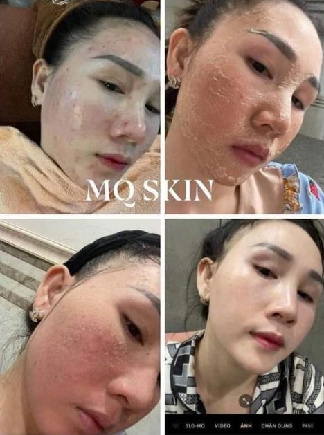 Nhiều khách hàng sử dụng Mq Skin thay da có hiệu quả