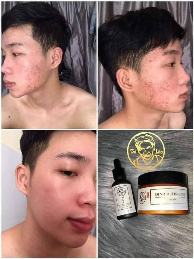 Serum trị mụn Bà Lão giúp ức chế và tiêu diệt vi khuẩn gây mụn ngay từ gốc