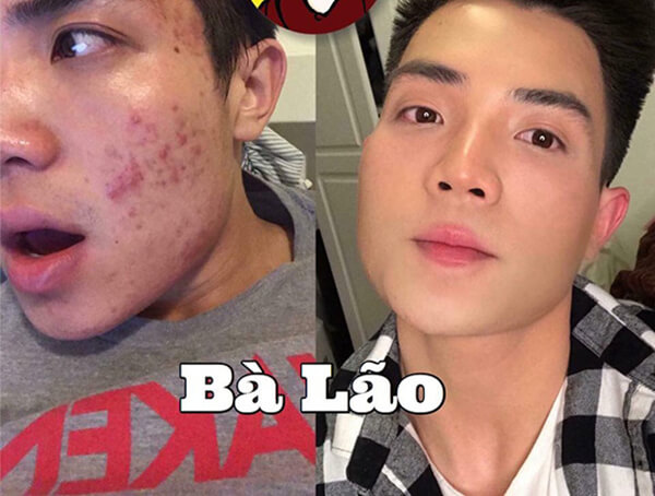Serum Trị Mụn Bà Lão Có Tốt Không?