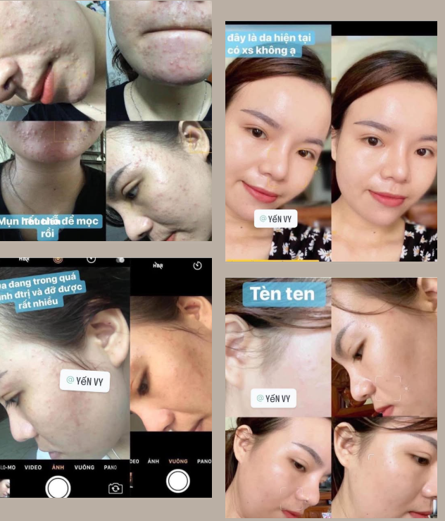 Hỗ trợ giảm tình trạng mụn và sưng đỏ trên da.